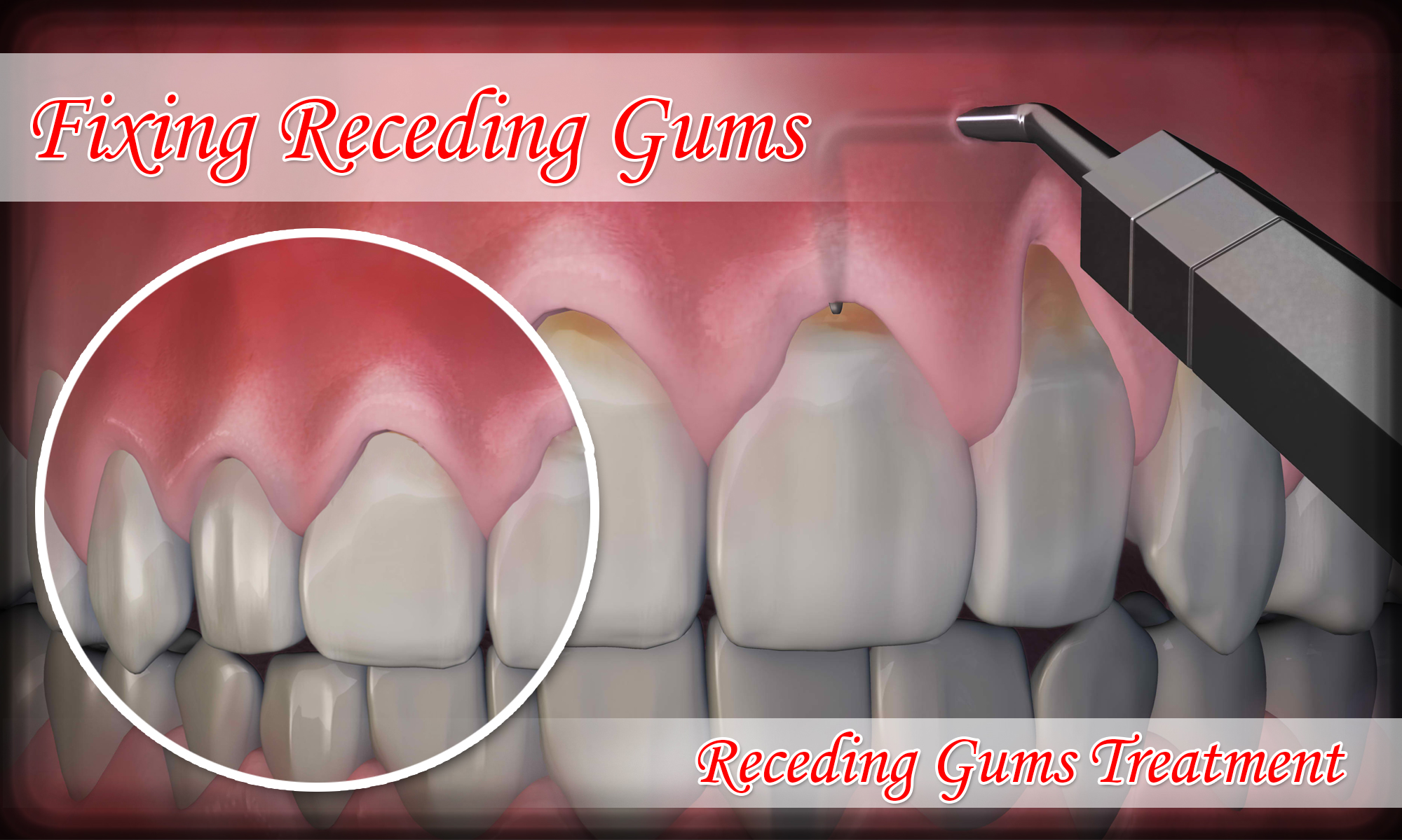 How do you fix receding gums?