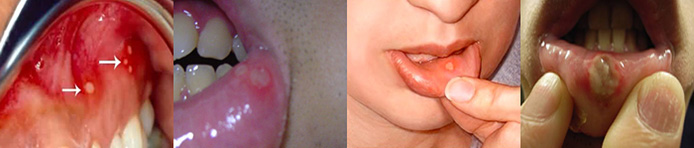 Progression of canker sores