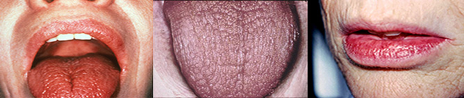 Progression of Dry Mouth