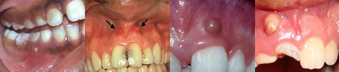Progression of gum boils