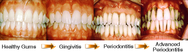 Progression of gum infection