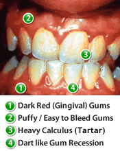 Healthy+gums+pictures