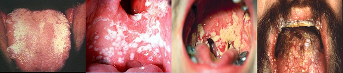 oral thrush