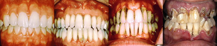 Progression of pyorrhea