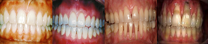 Progression of receding gums