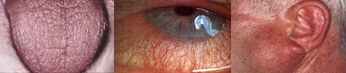 Progression of Sjogren's Syndrome