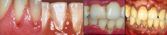 Progression of swollen gums