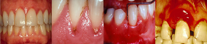 Progression of bleeding gums