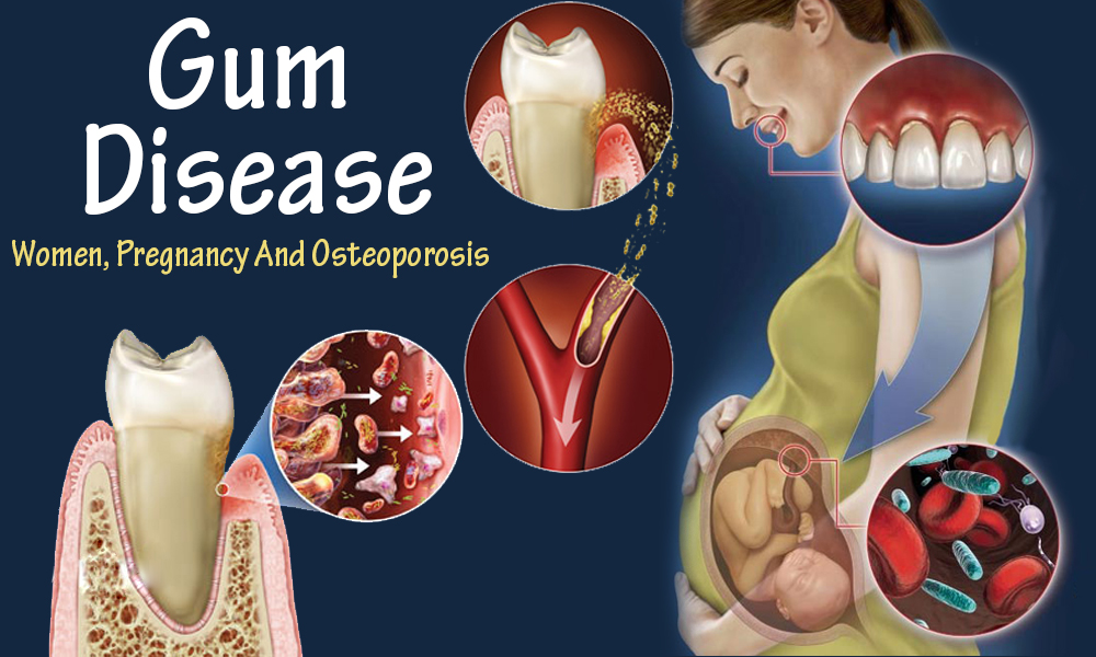 gum-disease-pregnancy