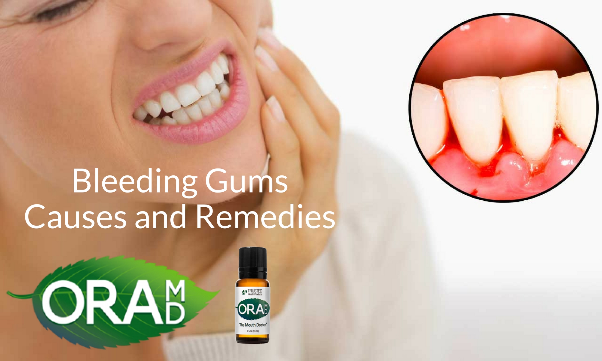 Bleeding Gums Causes and Remedies