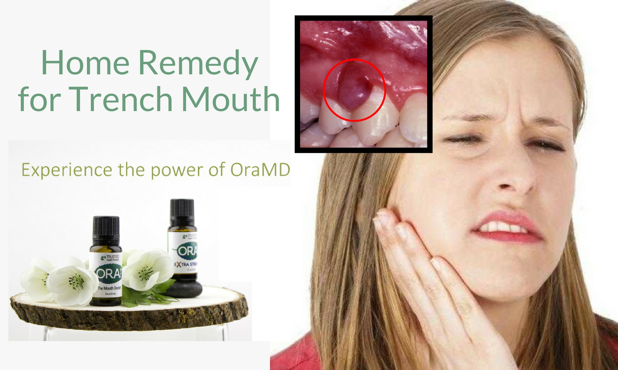 Home Remedy for Trench Mouth