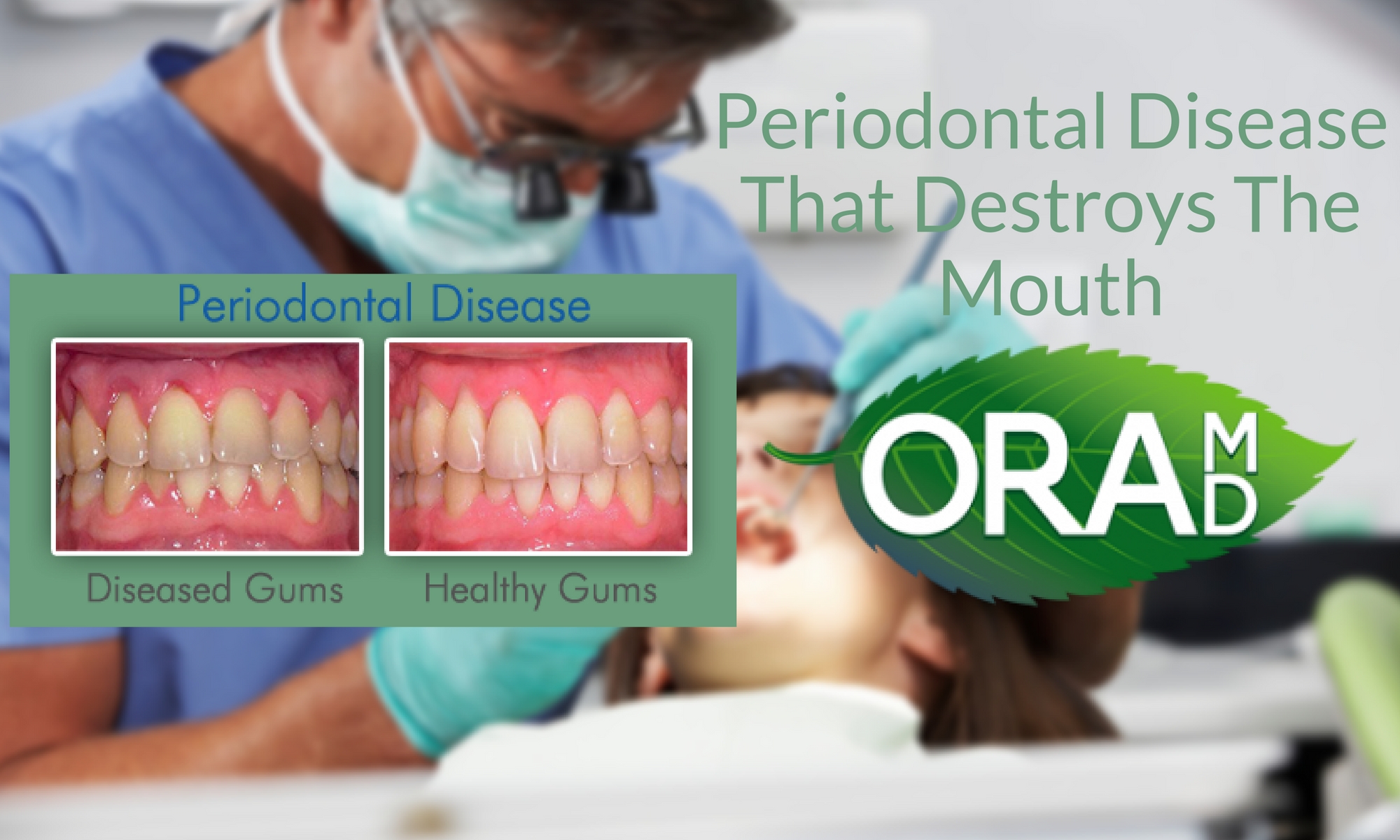 Periodontal Disease That Destroys The Mouth