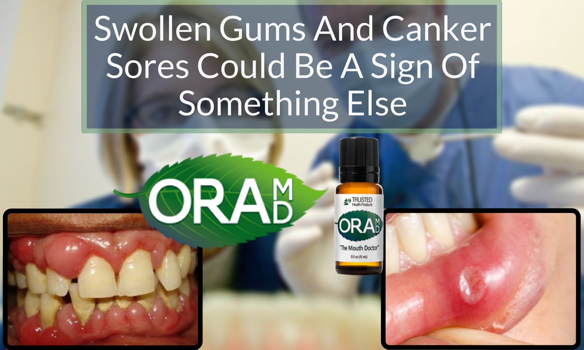 Swollen Gums And Canker Sores Could Be A Sign Of Something Else