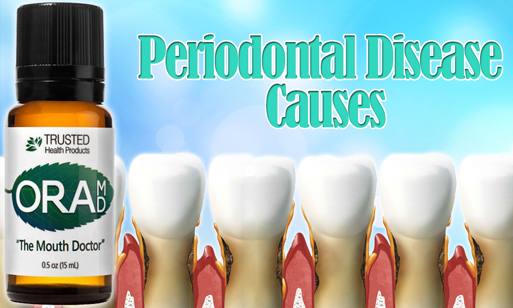 periodontal-disease-causes